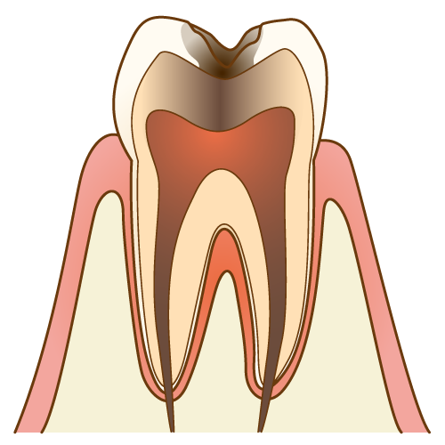 C3段階の虫歯