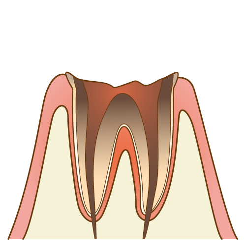 C4段階で歯根の先に膿がたまっている状態