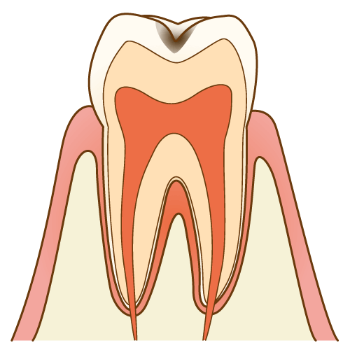 C1【エナメル質の虫歯】