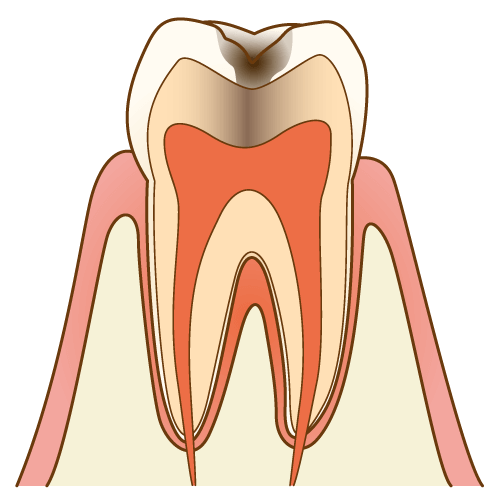 C2【象牙質の虫歯】