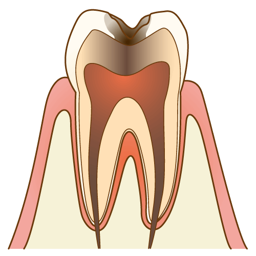 C3【神経まで達した虫歯】