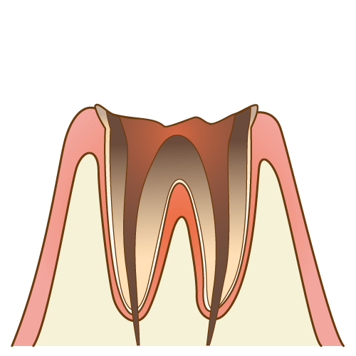 C4【歯根まで達した虫歯】