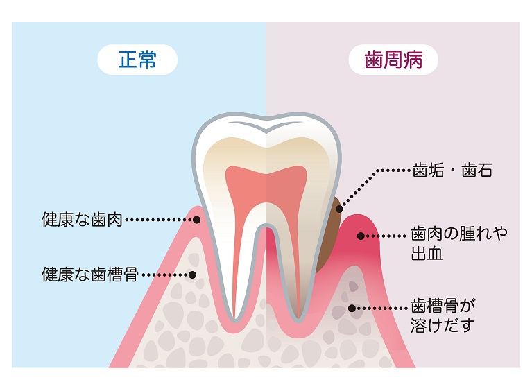 そもそも歯周病になる原因は？