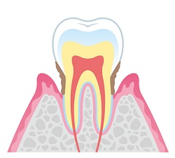 軽度歯周炎
