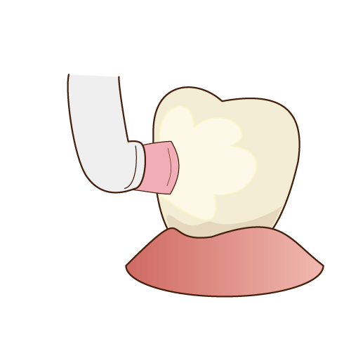 PMTC(歯のクリーニング)