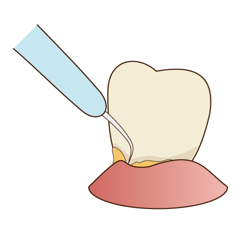 歯石除去(歯石取り)