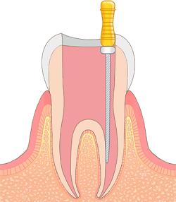 歯の神経を除去