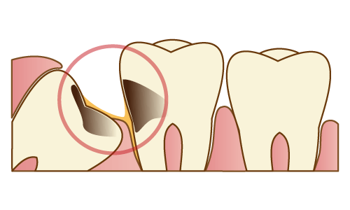 隣の歯の虫歯・歯周病の原因になっている