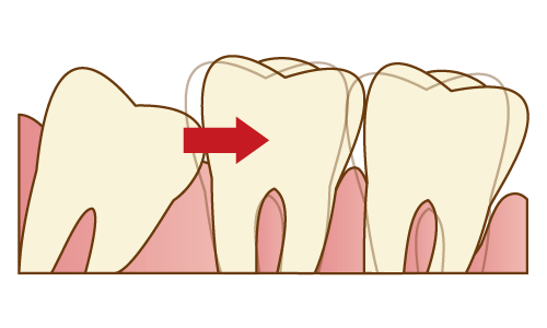 歯並びの乱れの原因になっている